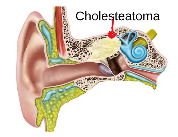 Cholesteatoma hearing loss.